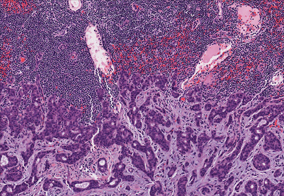 3D Breast Biopsy